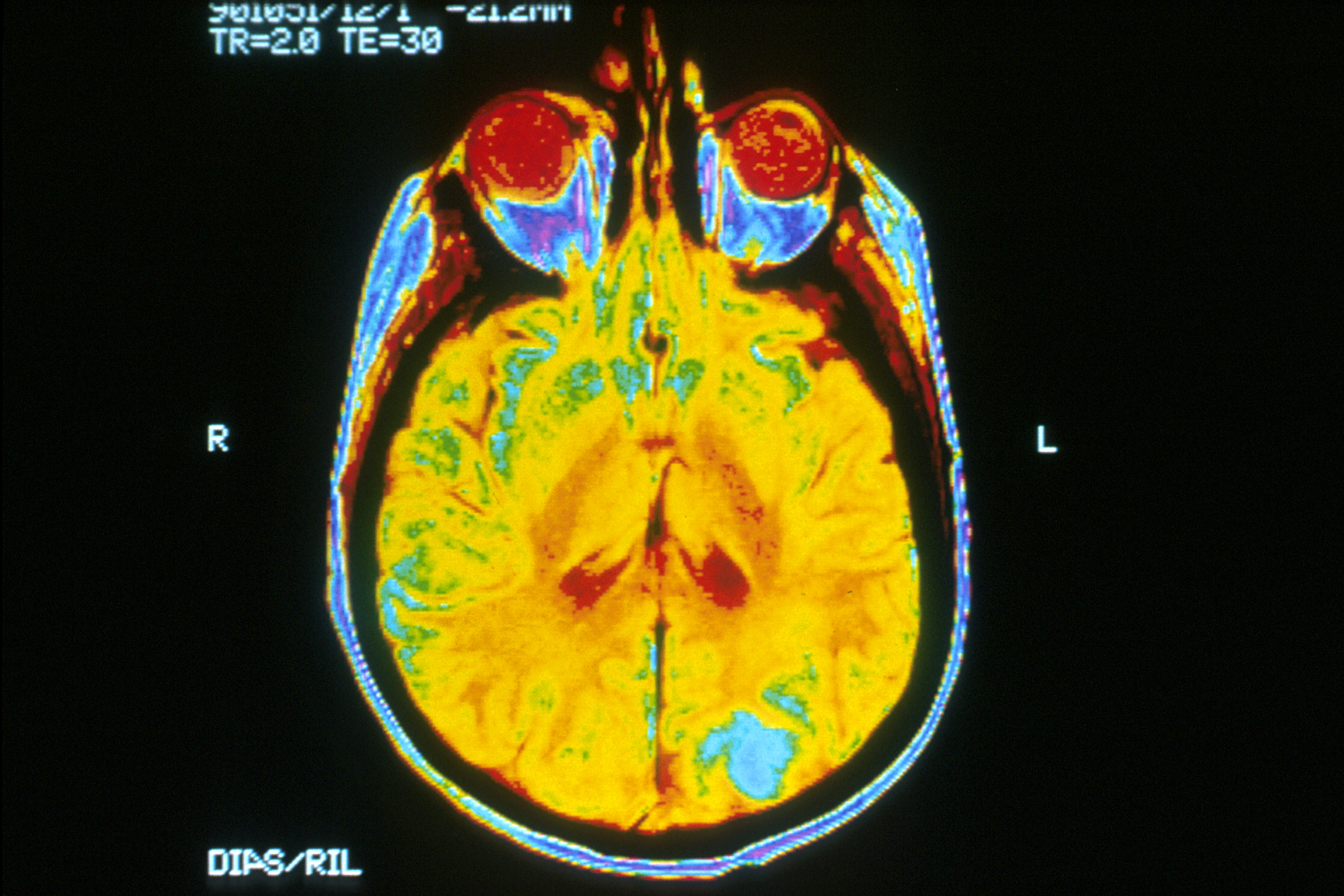 A historical color-coded MRI image of a human brain, with a blue-highlighted region toward the rear.