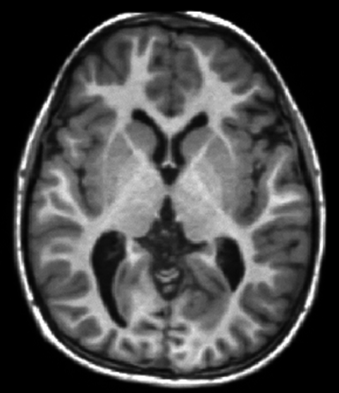 A grayscale T1-weighted axial MRI section of a human brain shows white- and gray-matter folds.