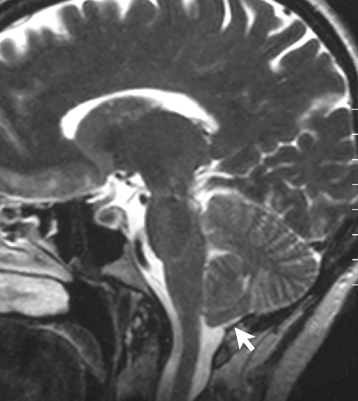 A sagittal MRI image shows the brain and upper spinal region in side section.
