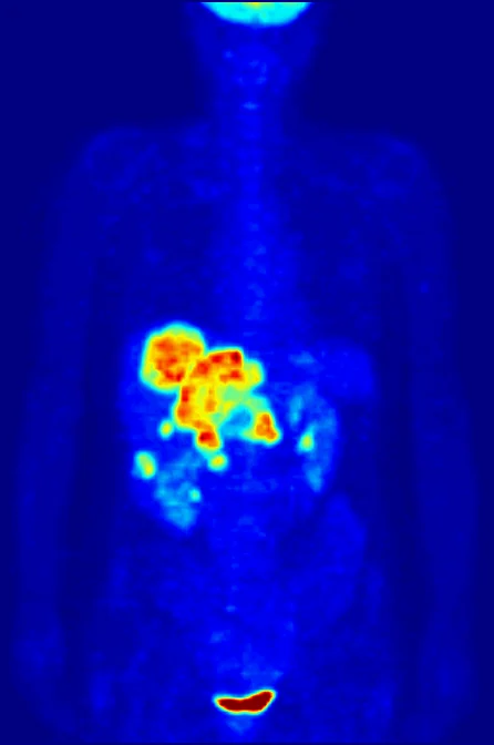 A whole-body PET maximum-intensity projection displays radiotracer activity against a dark background.