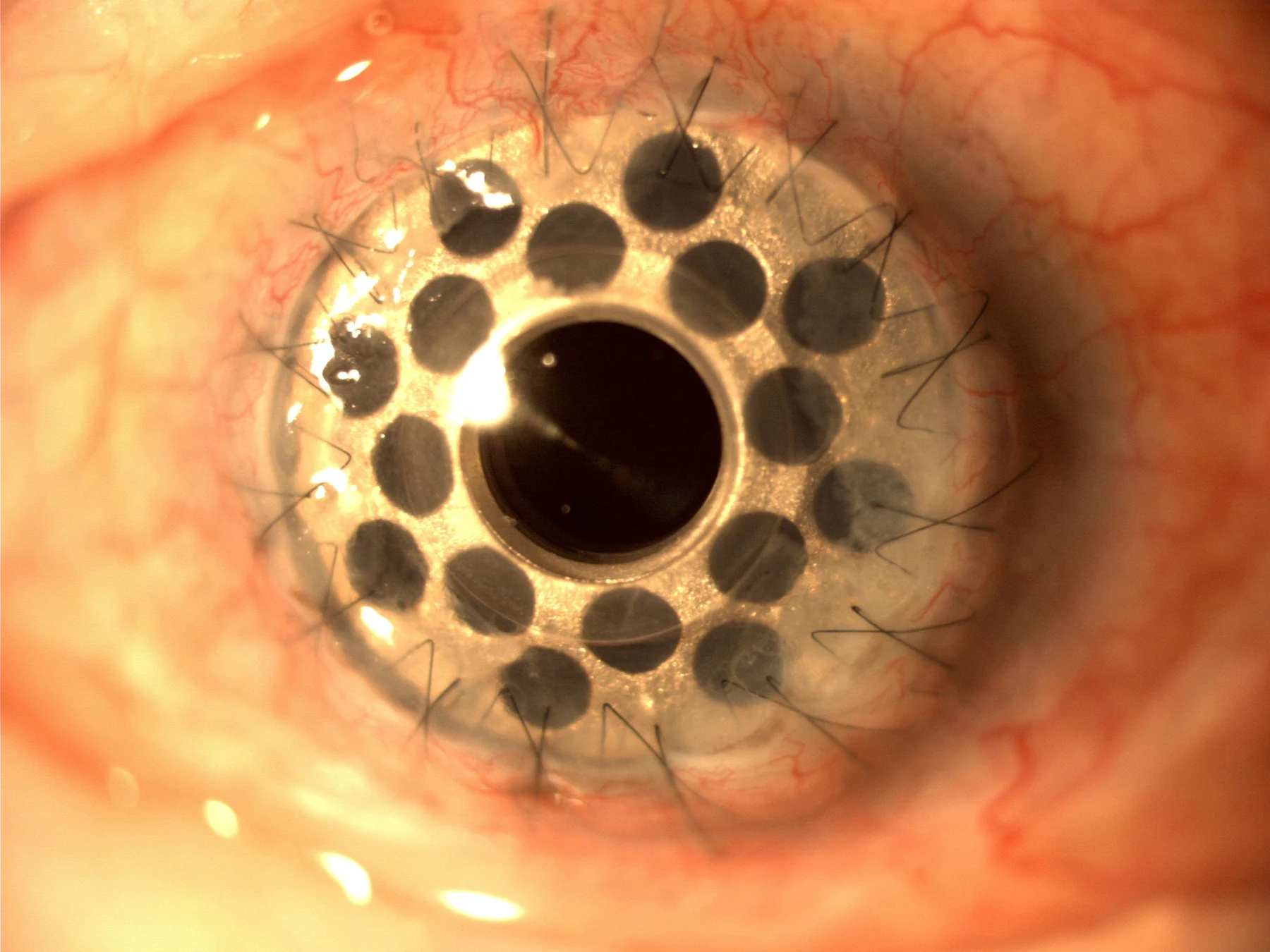 An artificial cornea with a perforated metallic ring is visible at the front of an eye.